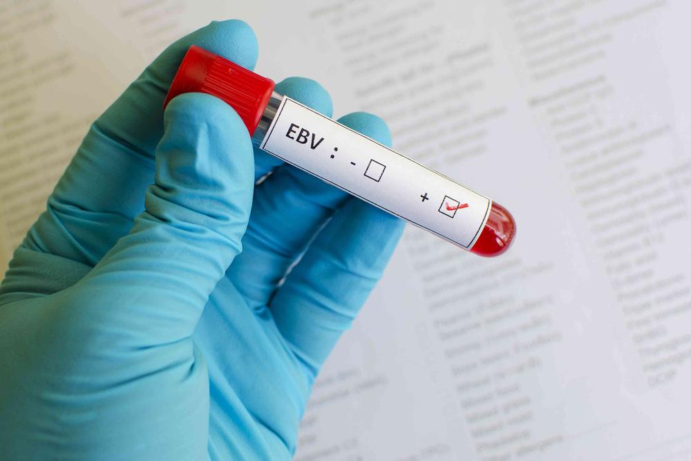 Discount Epstein Barr Virus Test Order EBV Testing Online Request A